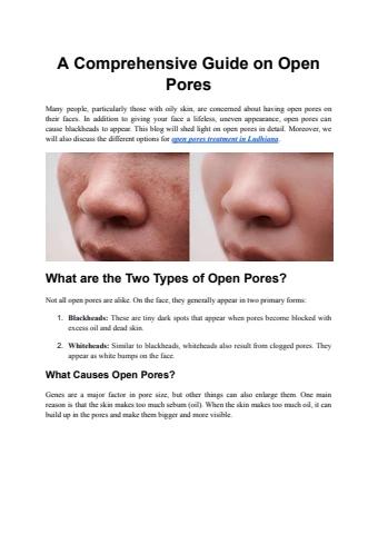 Open Pore Cyst A Comprehensive Guide on Open Pores